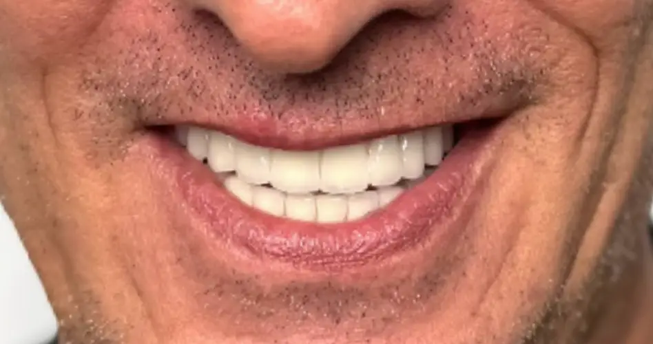 Dopo impianti zigomatici