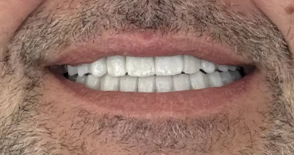 Dopo il trattamento