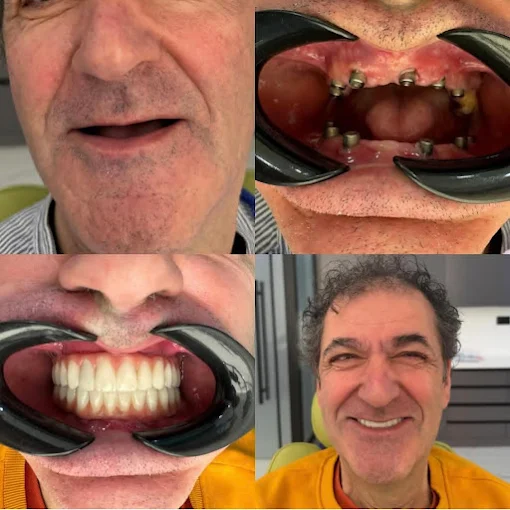 Trasformazione dentale paziente 2 - Prima e dopo