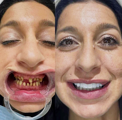 Trasformazione dentale paziente 3 - Prima e dopo